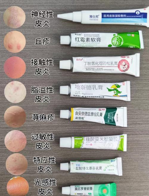 详细阅读:皮炎:常见皮肤问题全解析 皮炎:常见皮肤问题全解析