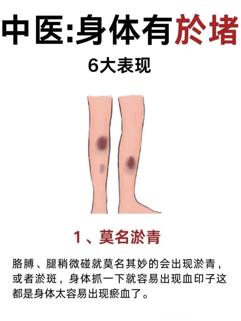 详细阅读:淤血:身体里的“隐形危机” 淤血:身体里的“隐形危机”