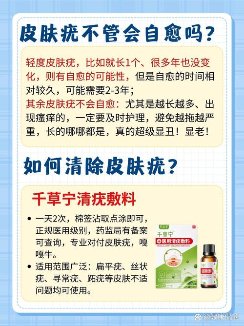寻常疣的治疗与去除：全面解析