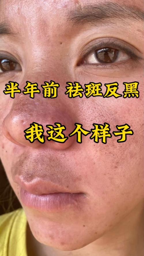 面部激光祛斑：重焕肌肤光彩的神奇之选