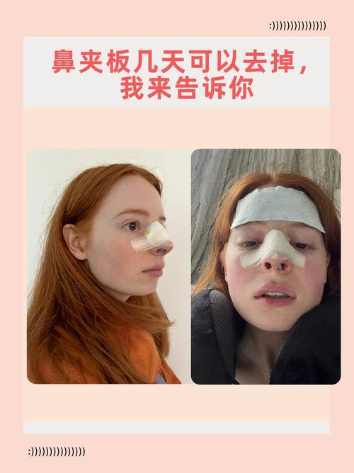 鼻夹：鼻腔健康的贴心守护者