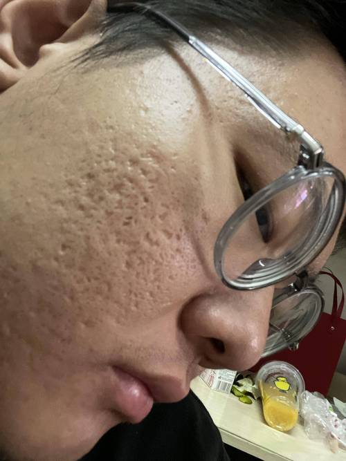 痘疤修复全攻略：重拾肌肤光滑，告别痘印困扰