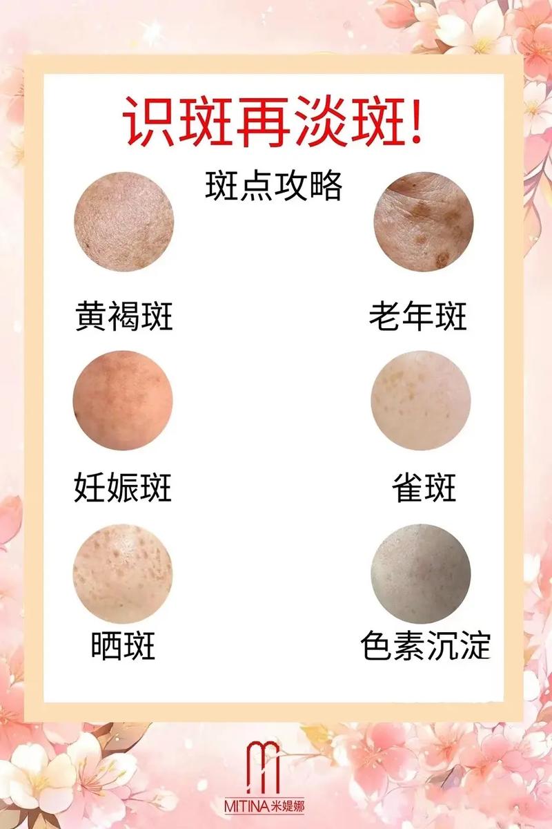 色斑的种类与去除方法全解析
