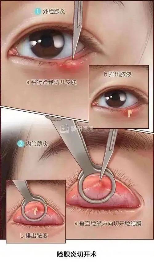 麦粒肿的治疗方法：全面解析与科学应对
