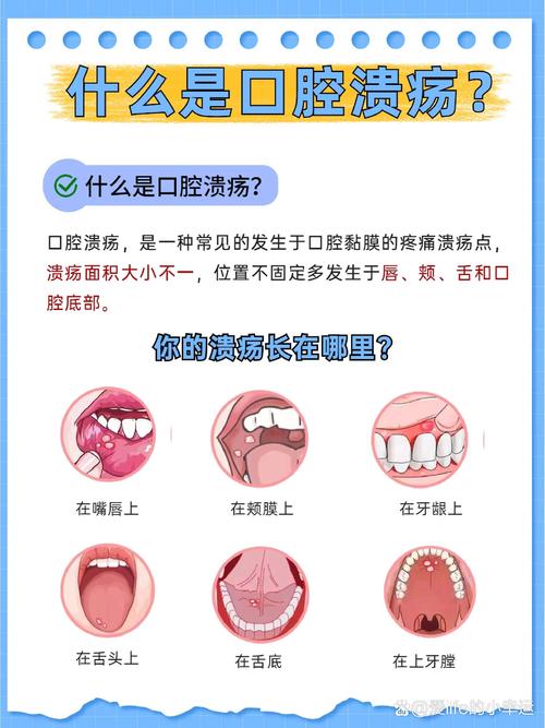 口腔溃疡的治疗全攻略：从诱因到康复