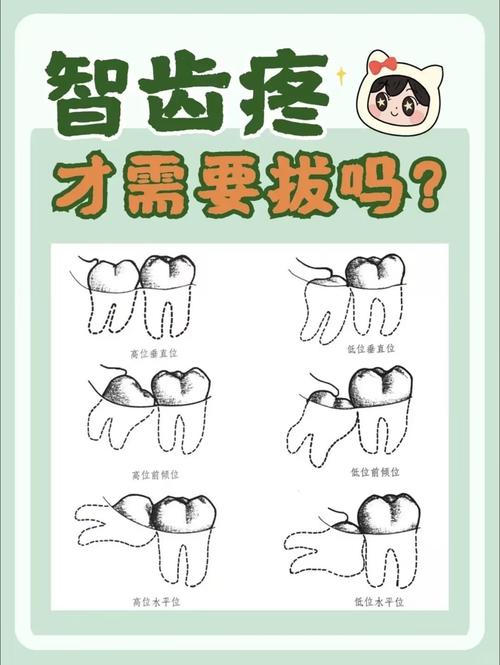 智齿：拔除与否的智慧抉择与治疗全解析