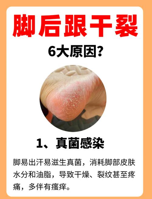 足部干裂修复全攻略：从成因到日常护理，重焕双脚健康