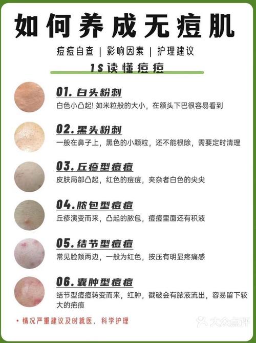 痘痘肌护理全攻略：重拾肌肤清爽与自信
