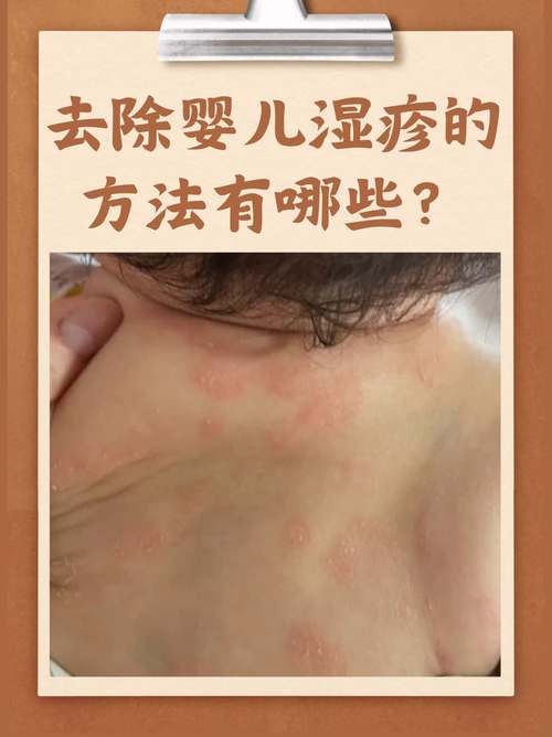 宝宝防湿疹全攻略：守护宝贝肌肤，远离湿疹困扰