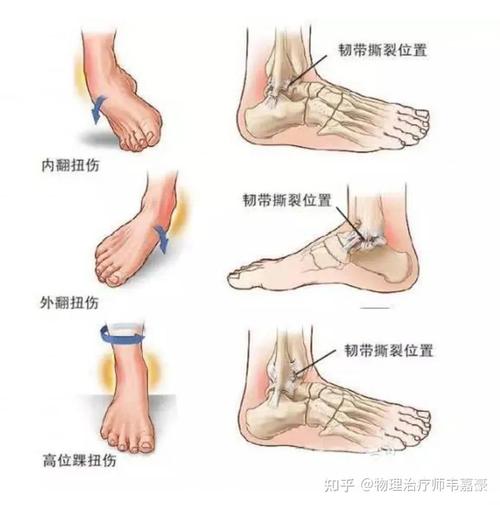 关节扭伤：原因、症状、治疗与预防全解析