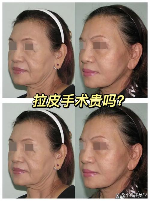 拉皮手术年轻化：重拾青春的“魔法”