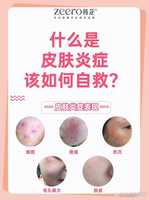 皮肤炎症消除：全面攻略与深度解析