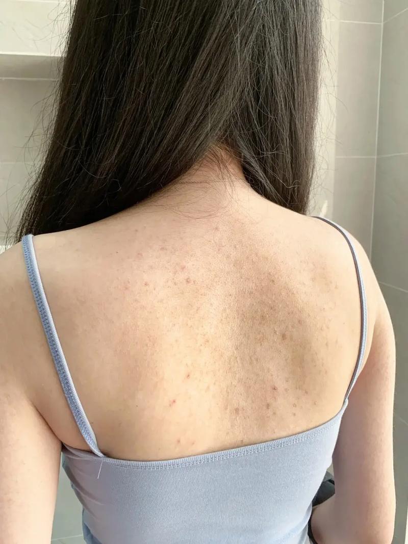 皮肤炎症：反复发作的背后