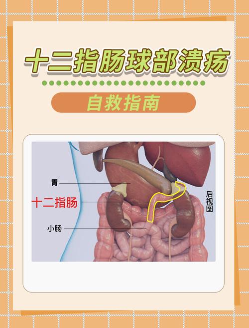 十二指肠溃疡治疗：全面解析与康复指南