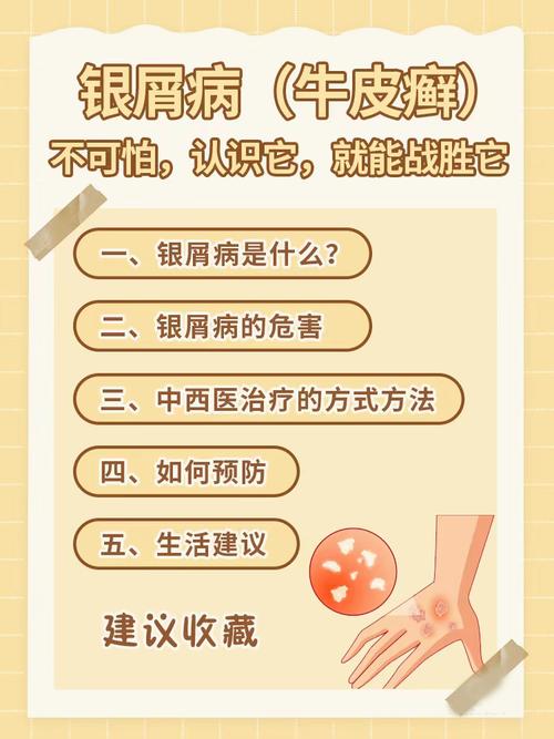 详细阅读:牛皮癣的治疗与控制 牛皮癣的治疗与控制