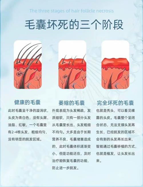 遗传性脱发与头皮护理：全面解析与实践指南