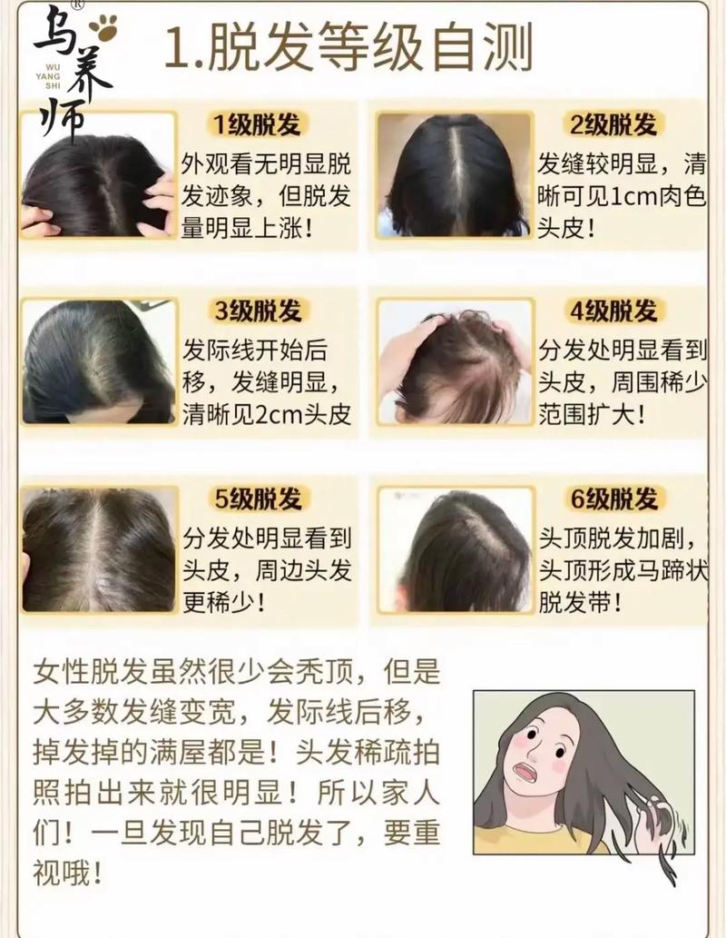 详细阅读:头发护理:遗传性脱发防脱方法全解析 头发护理:遗传性脱发防脱方法全解析