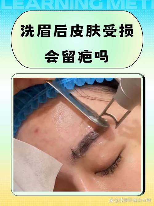 详细阅读:激光洗眉的原理与注意事项 激光洗眉的原理与注意事项