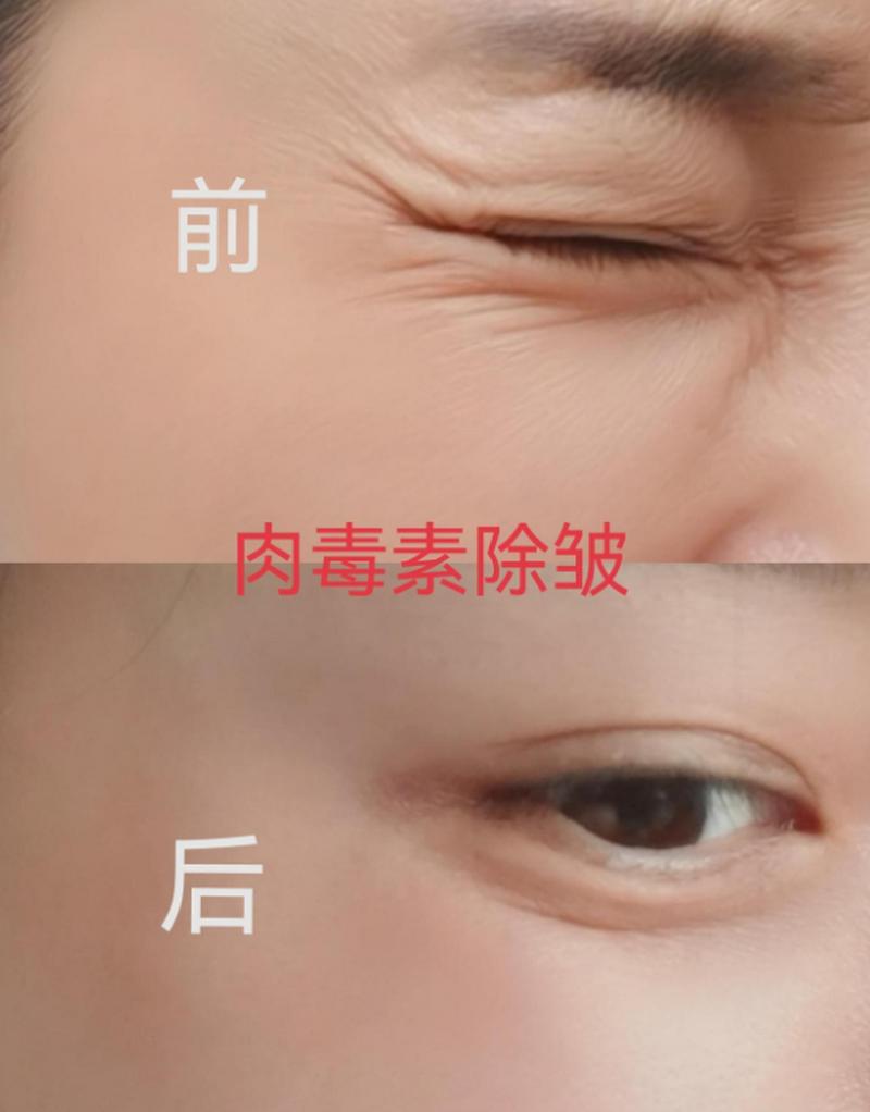 揭秘肉毒素除皱：重绽年轻光彩的神奇密码