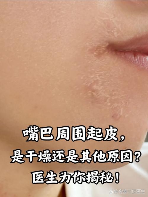 详细阅读:皮肤干燥:原因剖析与全面解决之道 皮肤干燥:原因剖析与全面解决之道