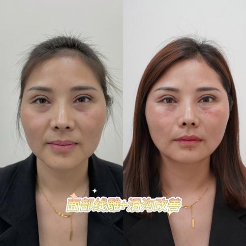 详细阅读:线雕美容介绍与恢复过程 线雕美容介绍与恢复过程