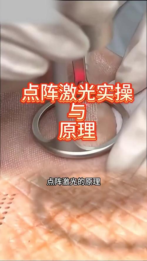详细阅读:点阵激光治疗:原理、作用与应用 点阵激光治疗:原理、作用与应用