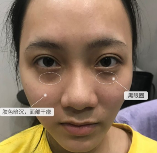 详细阅读:眼部黑眼圈减轻:多维度探寻改善之法,重焕双眸光彩 眼部黑眼圈减轻:多维度探寻改善之法,重焕双眸光彩