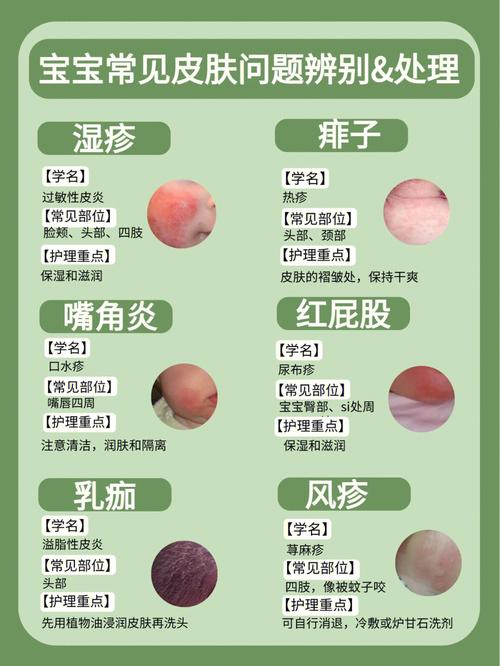 详细阅读:湿疹:认识、应对与预防全攻略 湿疹:认识、应对与预防全攻略