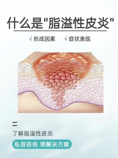 详细阅读:全面解析皮炎:成因、危害与防治全攻略 全面解析皮炎:成因、危害与防治全攻略