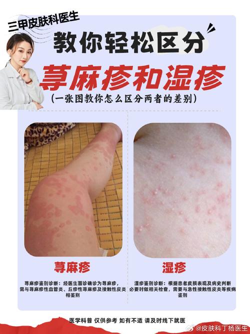 详细阅读:荨麻疹:了解与应对这种常见的皮肤疾病 荨麻疹:了解与应对这种常见的皮肤疾病
