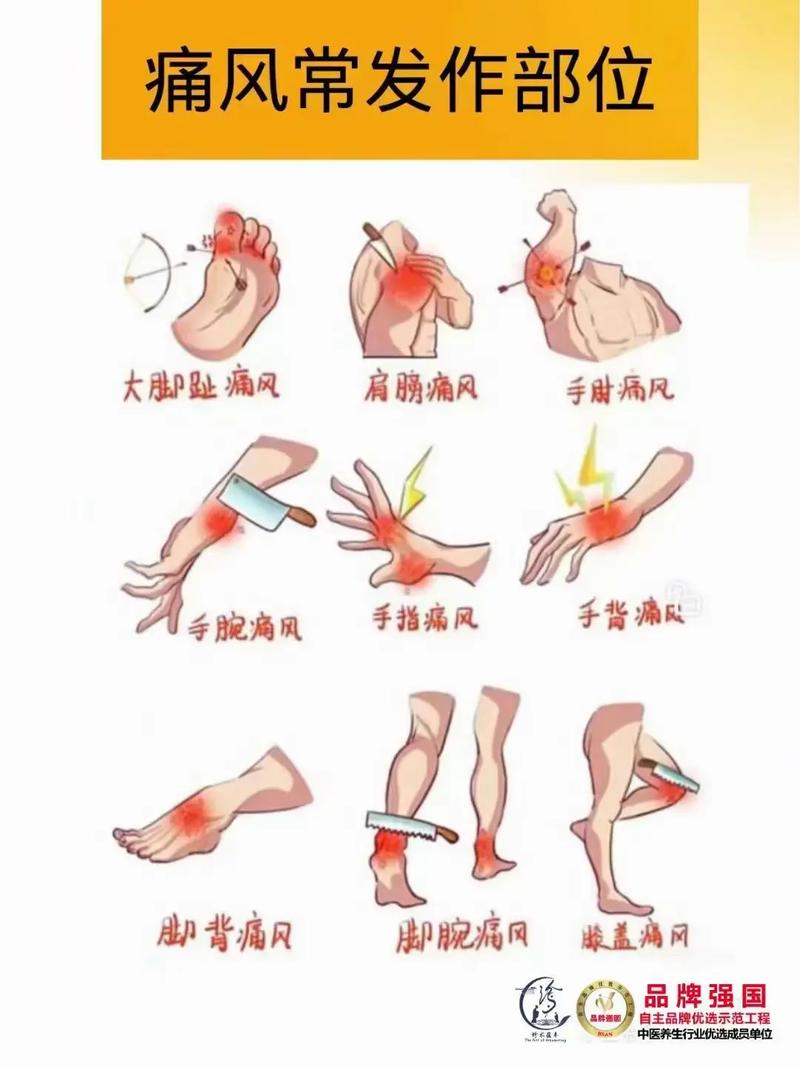 详细阅读:痛风:古老疾病的现代挑战与应对 痛风:古老疾病的现代挑战与应对