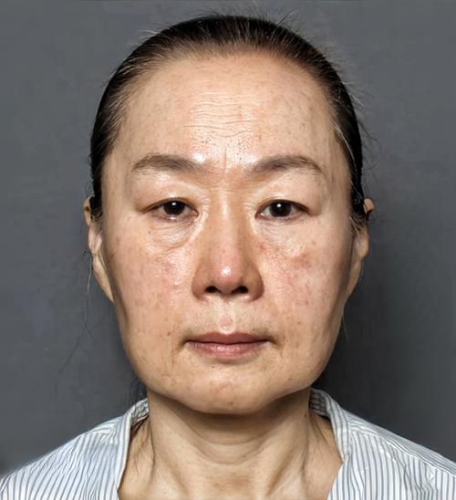 详细阅读:拉皮手术年轻化:追求美的新趋势与多维度考量 拉皮手术年轻化:追求美的新趋势与多维度考量