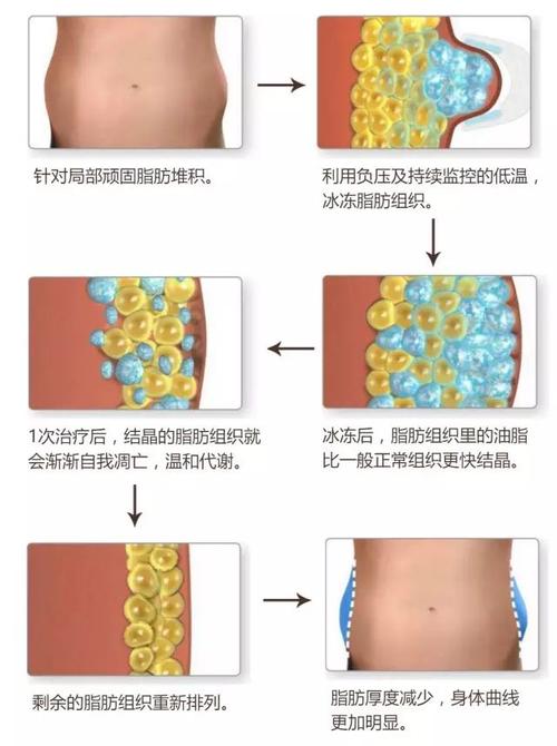 冷冻溶脂：开启安全高效减脂新境界
