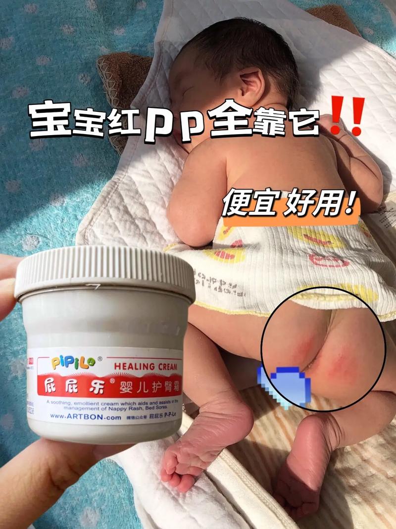 儿童护臀膏：宝宝臀部的贴心守护者