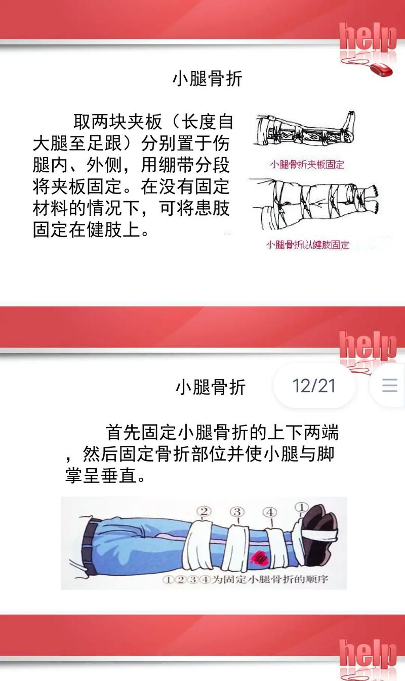 详细阅读:骨折的急救与固定:守护生命的坚实防线 骨折的急救与固定:守护生命的坚实防线
