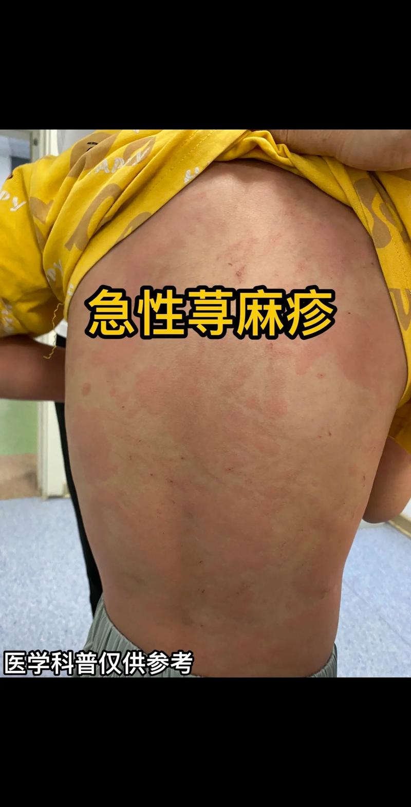 荨麻疹,荨麻疹怎么治疗最好最快最有效