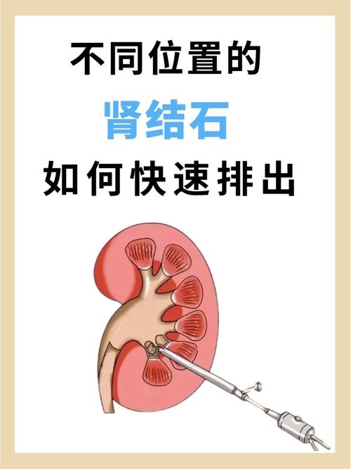 肾结石,肾结石疼怎么办快速止疼