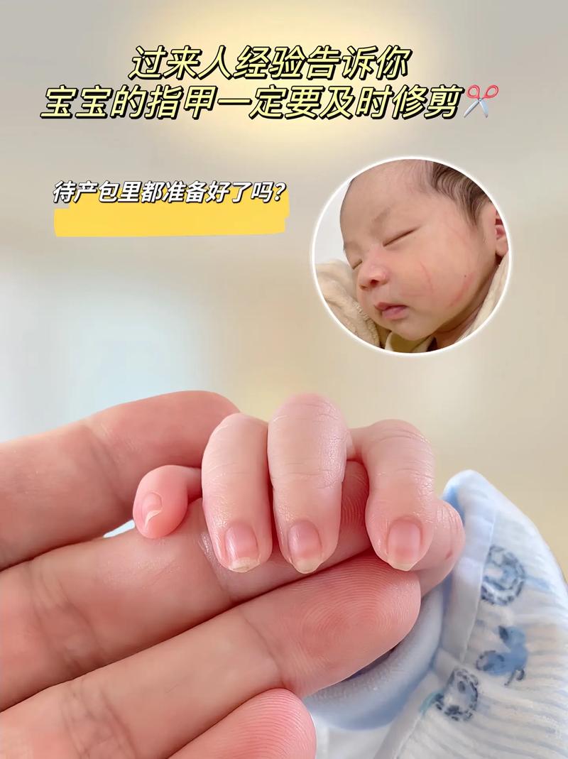 婴儿指甲剪,婴儿指甲剪到肉出血了