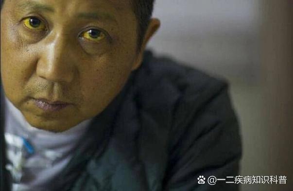 肝炎,肝炎有哪些症状
