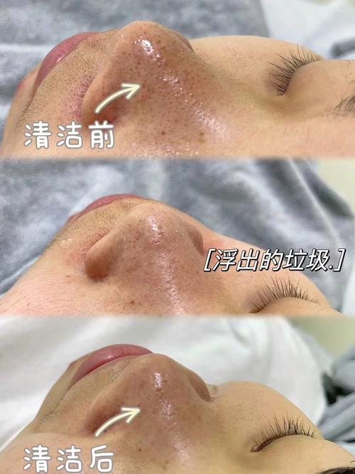 黑头清理技巧,黑头清理技巧视频