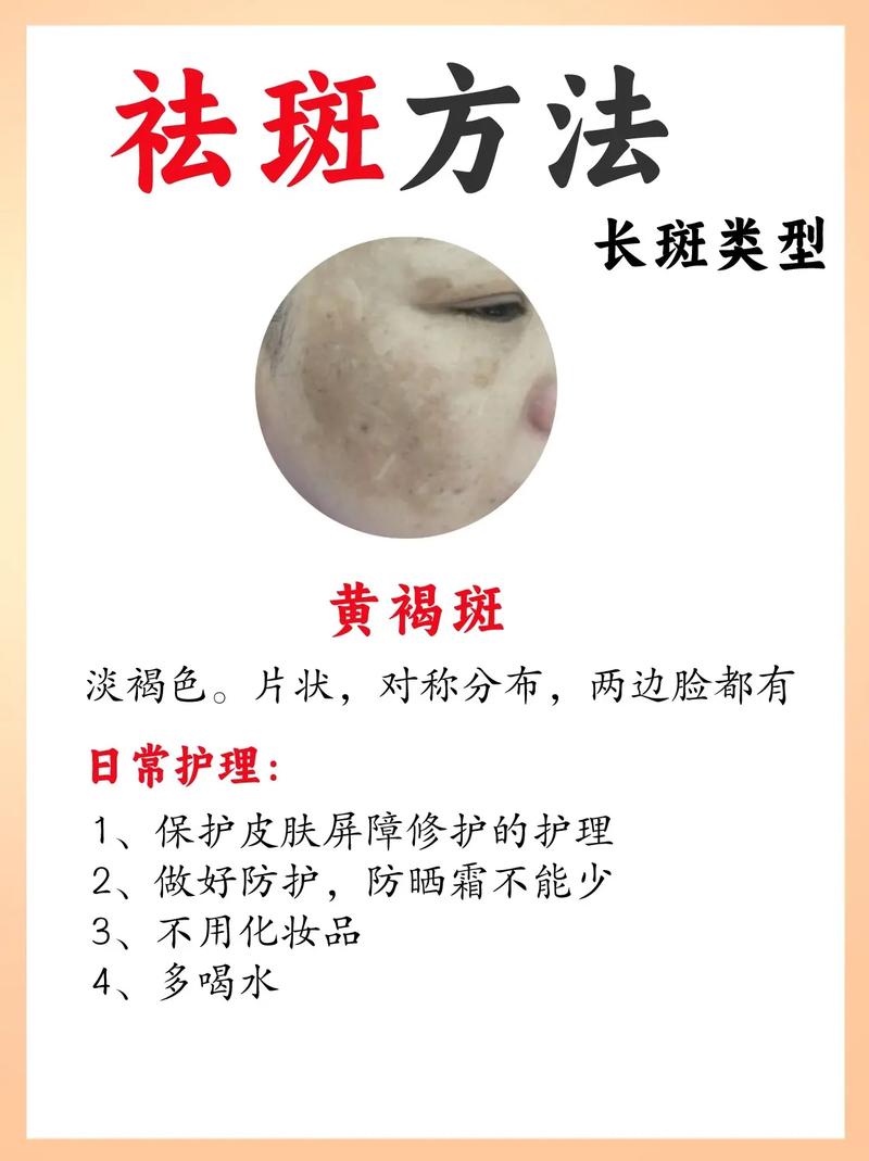 色斑成因与防治,色斑成因与防治方法