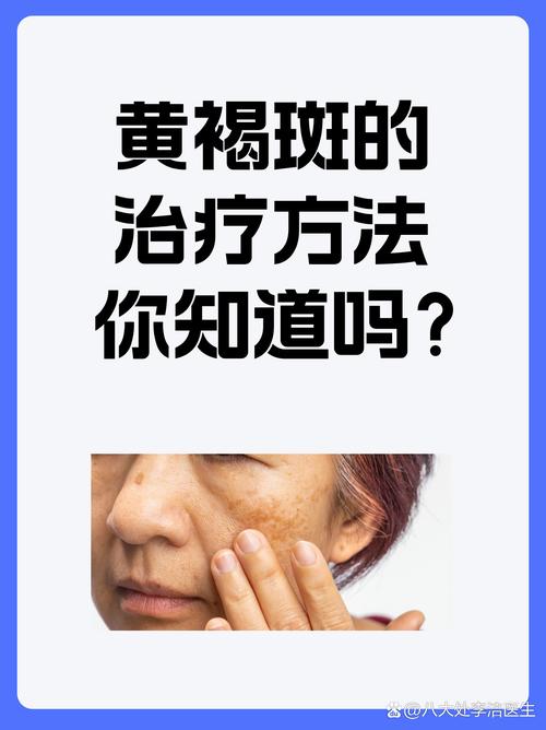 黄褐斑去除,黄褐斑去除的最佳方法