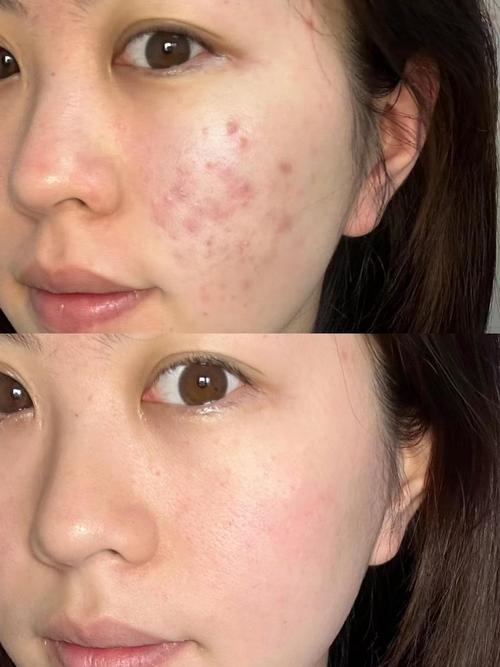 黄金微针美容效果与过程,黄金微针美容作用