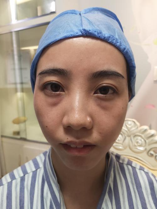眼部眼袋消除,眼部眼袋消除妙招